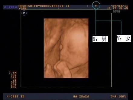  b超数据如何看待胎儿性别