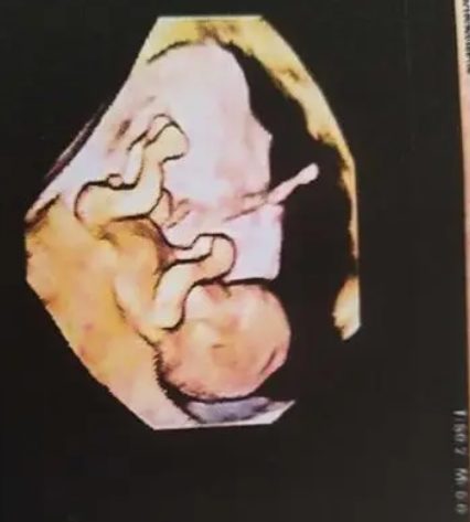  怀孕怎么知道男宝女宝?能把脉从男女身上拿出来吗?